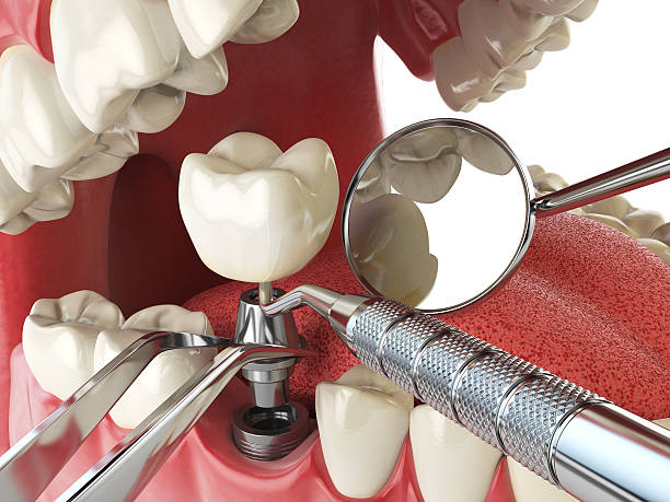 Best Urgent Care for Lost Fillings or Crowns in Wagon Wheel, AZ